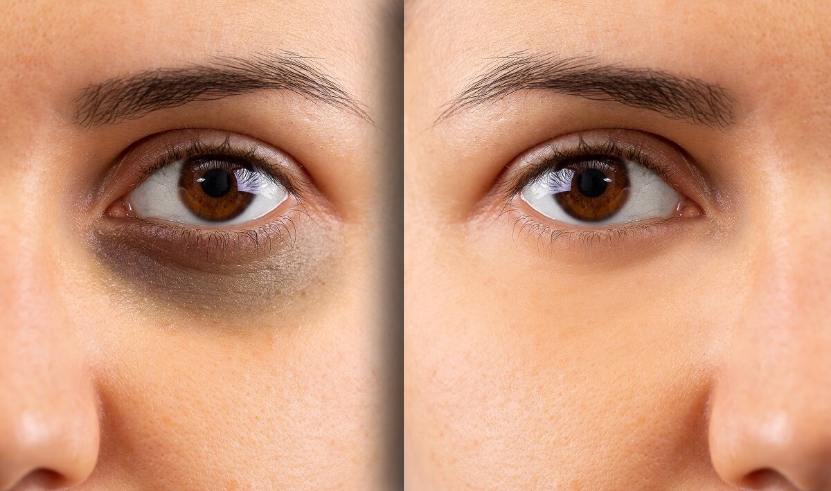 semaglutide dark circles under eyes Eye Fillers What Is 'Ozempic Face' and