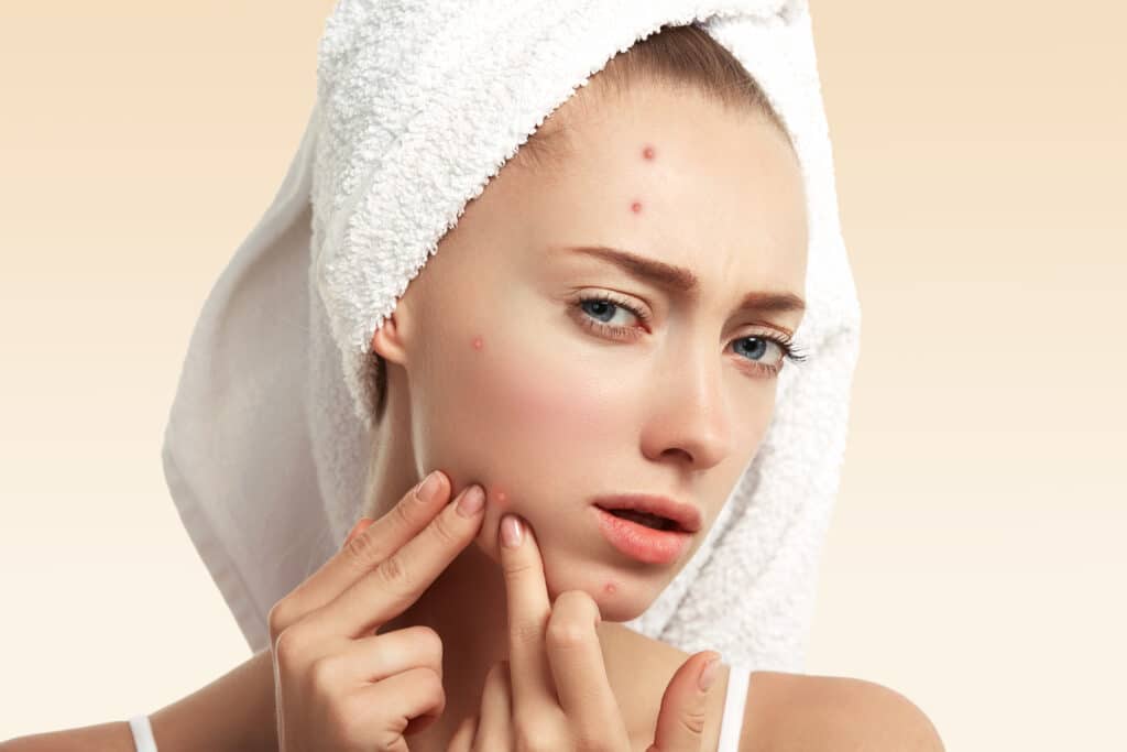 Acne Treatment - Price - Istanbul, Turkey | Quartz Clinique