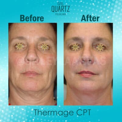 Lifting du Visage Non Chirurgical