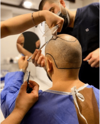 Fue Haartransplantation