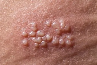 Genital Herpes