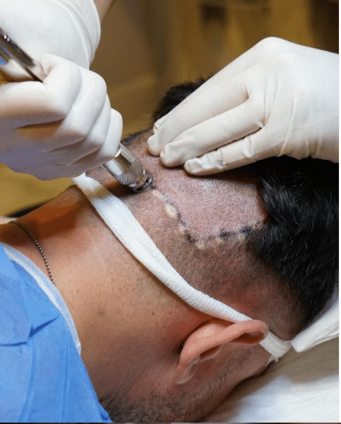 DHI-Haartransplantation