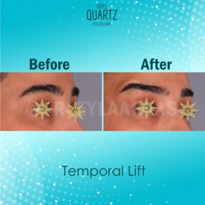 Temporal Lift