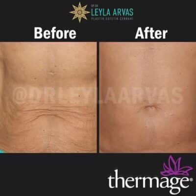 Thermage CPT Body