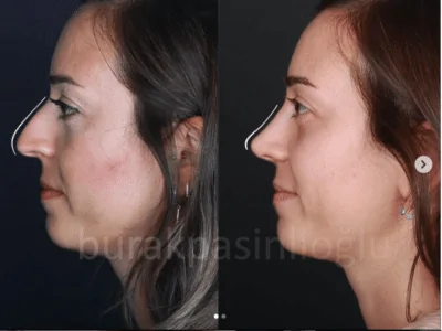 تجميل الانف