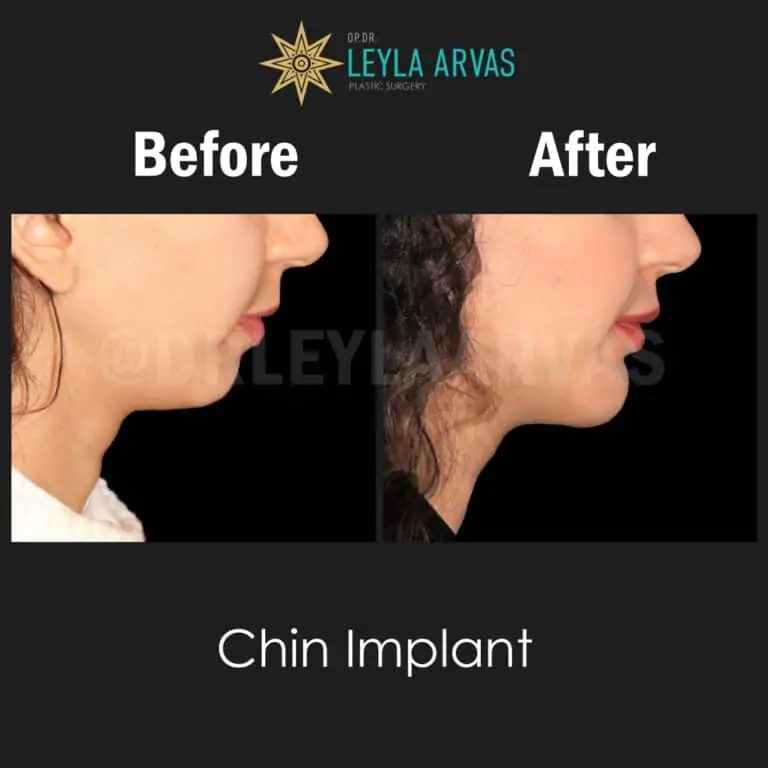 تجميل الفك تجميل الفك