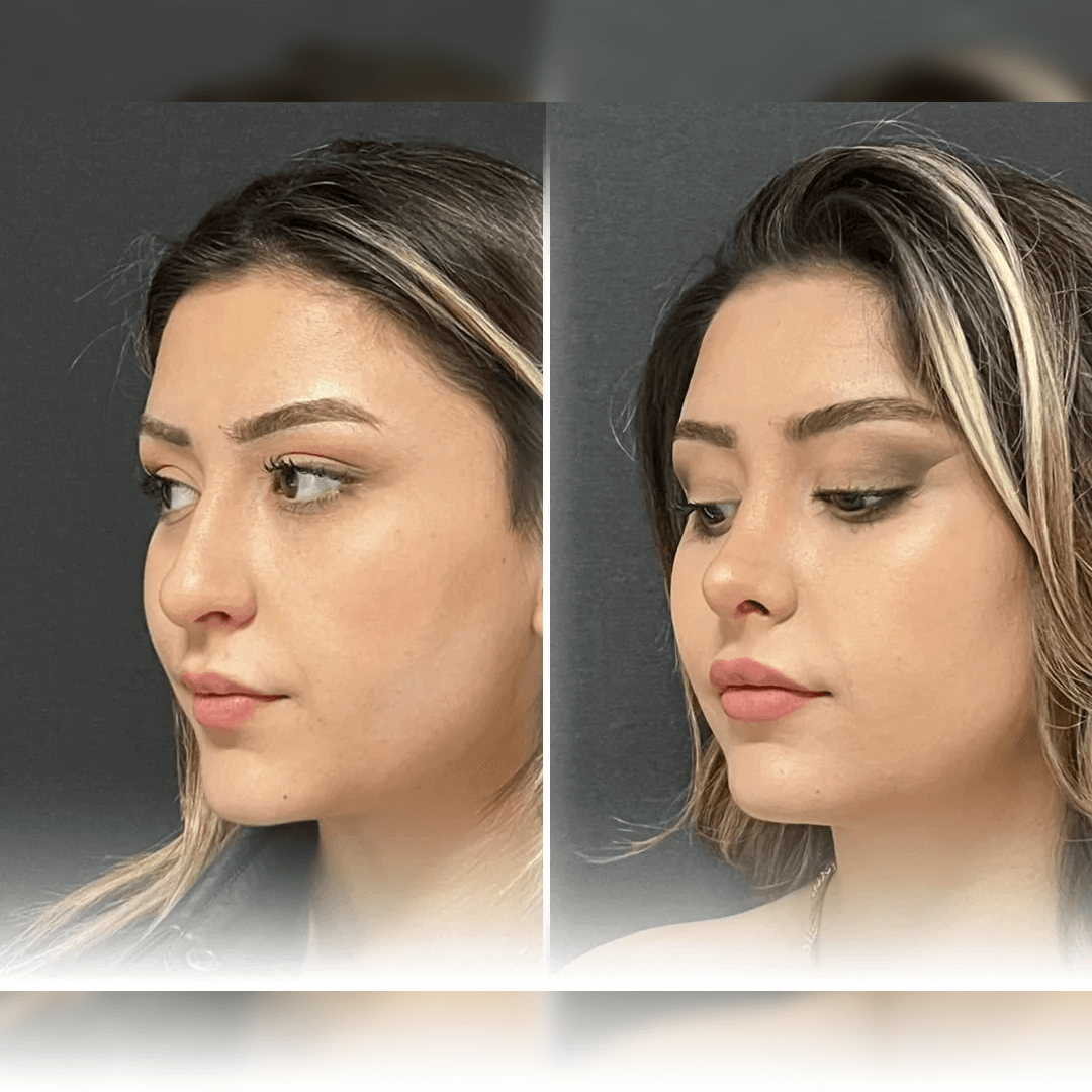 rinoplasti-before-after-5