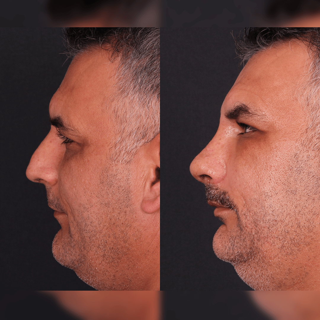 rinoplasti-before-after-6