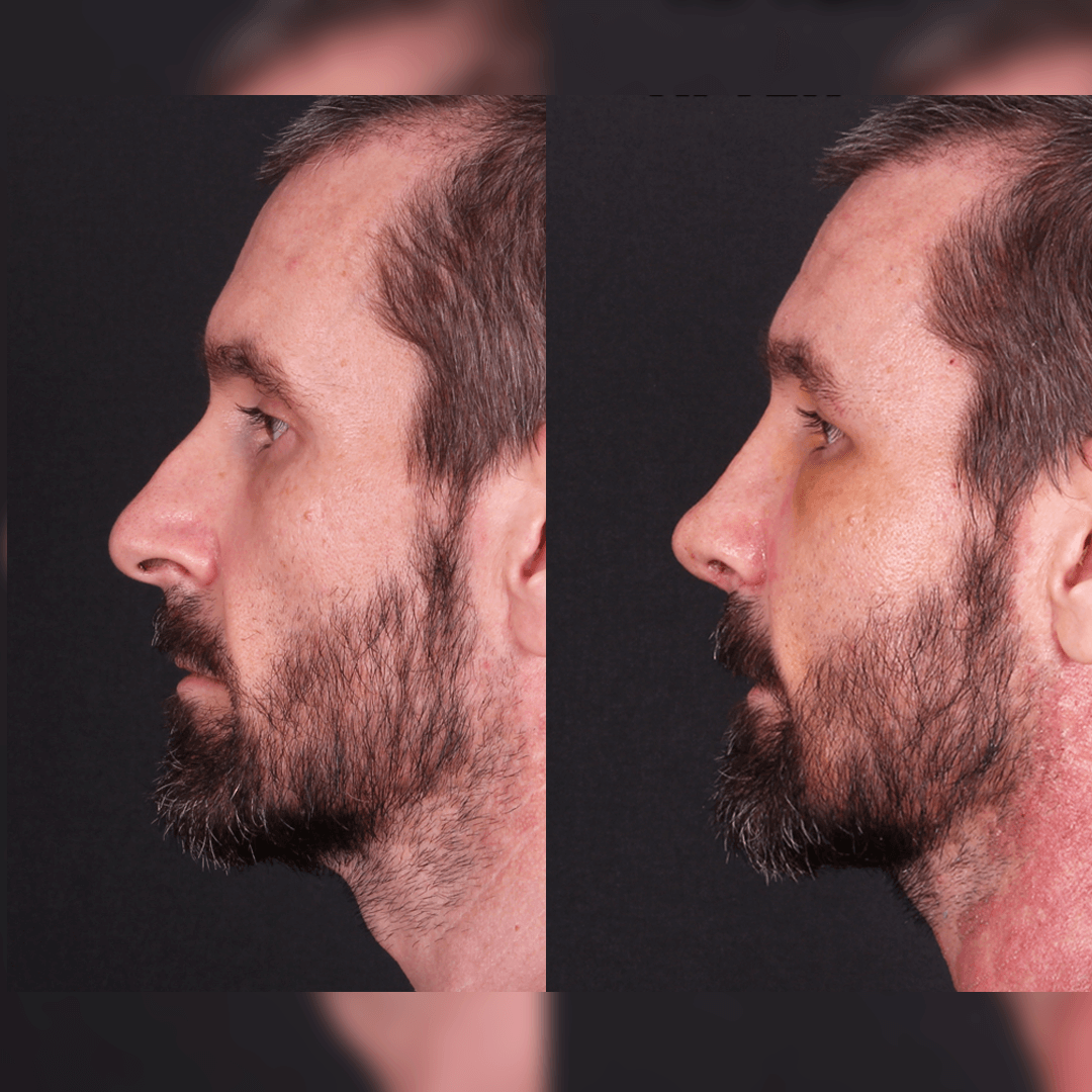 rinoplasti-before-after-7
