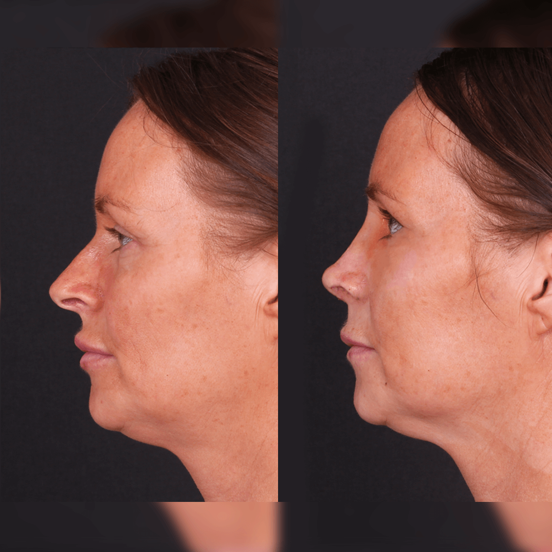 rinoplasti-before-after-8