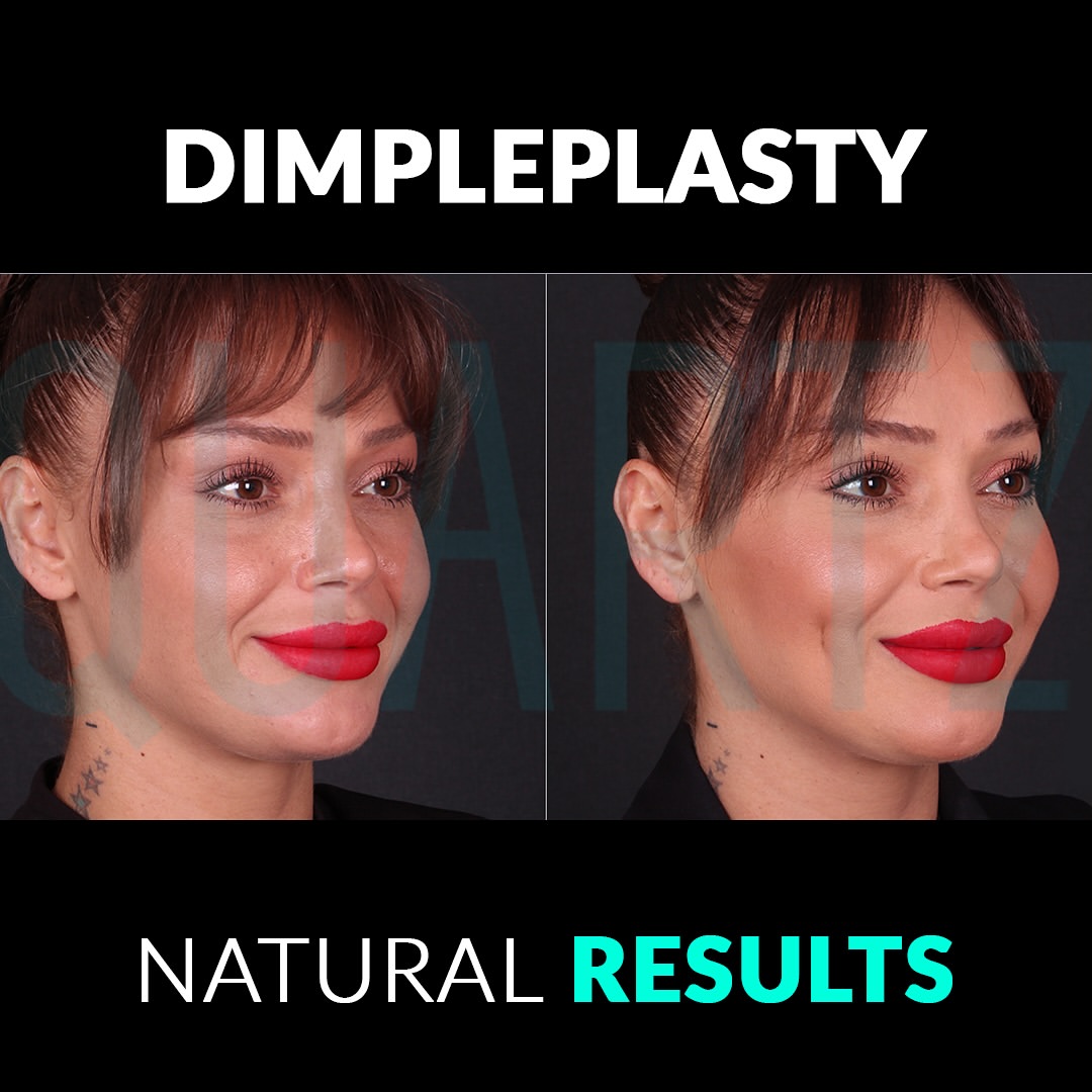 Dimpleplasty
