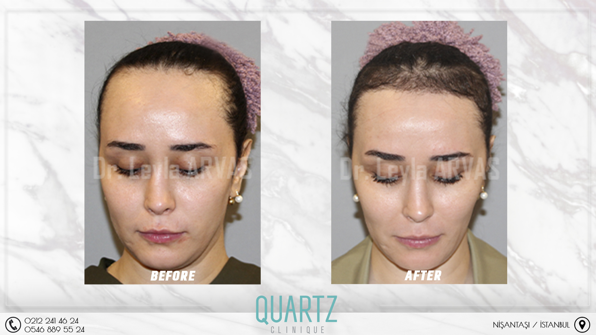 Female Hair Transplant Female Hair Transplant