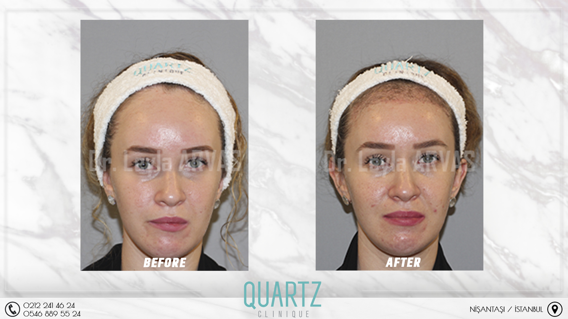 Female Hair Transplant Female Hair Transplant
