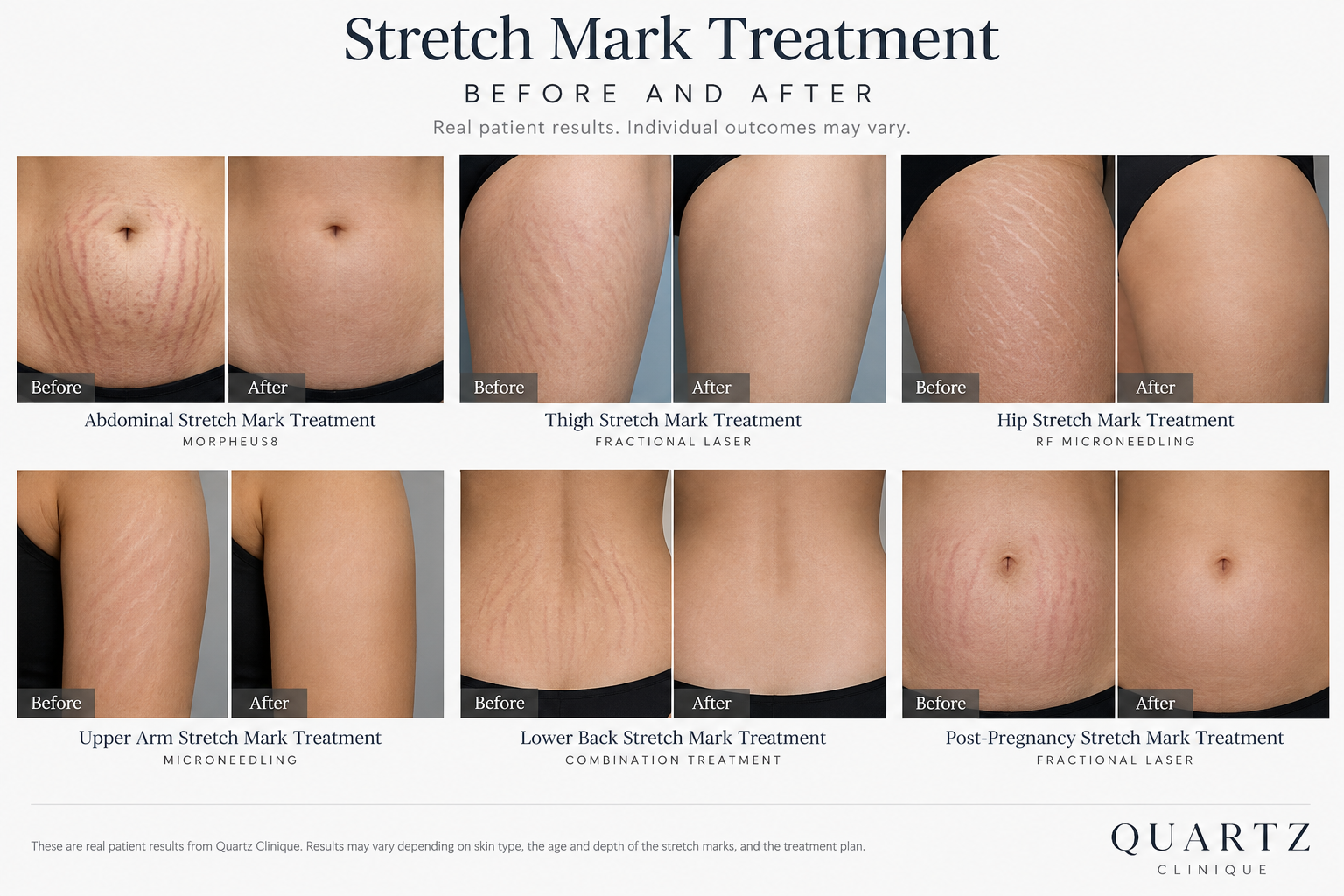 Stretch Mark Treatment Stretch Mark Treatment
