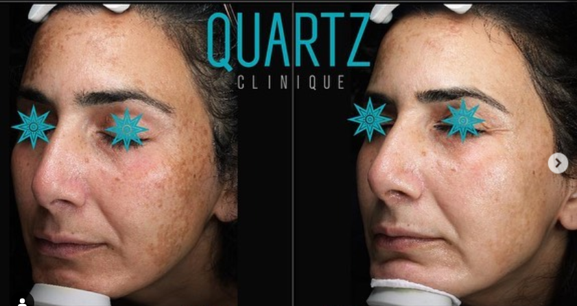 Pigmentation Treatment Pigmentation Treatment