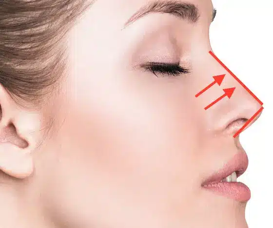 تجميل الأنف بالخيوط تجميل الأنف بالخيوط