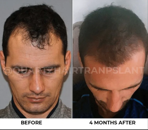 زراعة الشعر زراعة الشعر