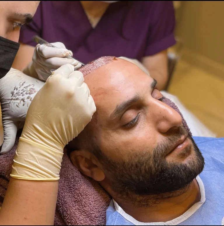 زرع الشعر زرع الشعر