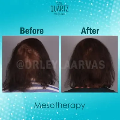ميزوثيرابي الشعر ما هو الميزوثيرابي؟