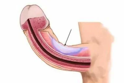 penis egriligi 1.jpg1