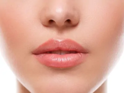 lip lift