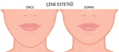 çene