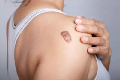 Keloid Tedavisi
