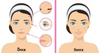 Botox etkisi