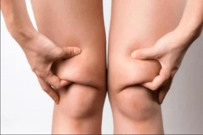 Knee Liposuction