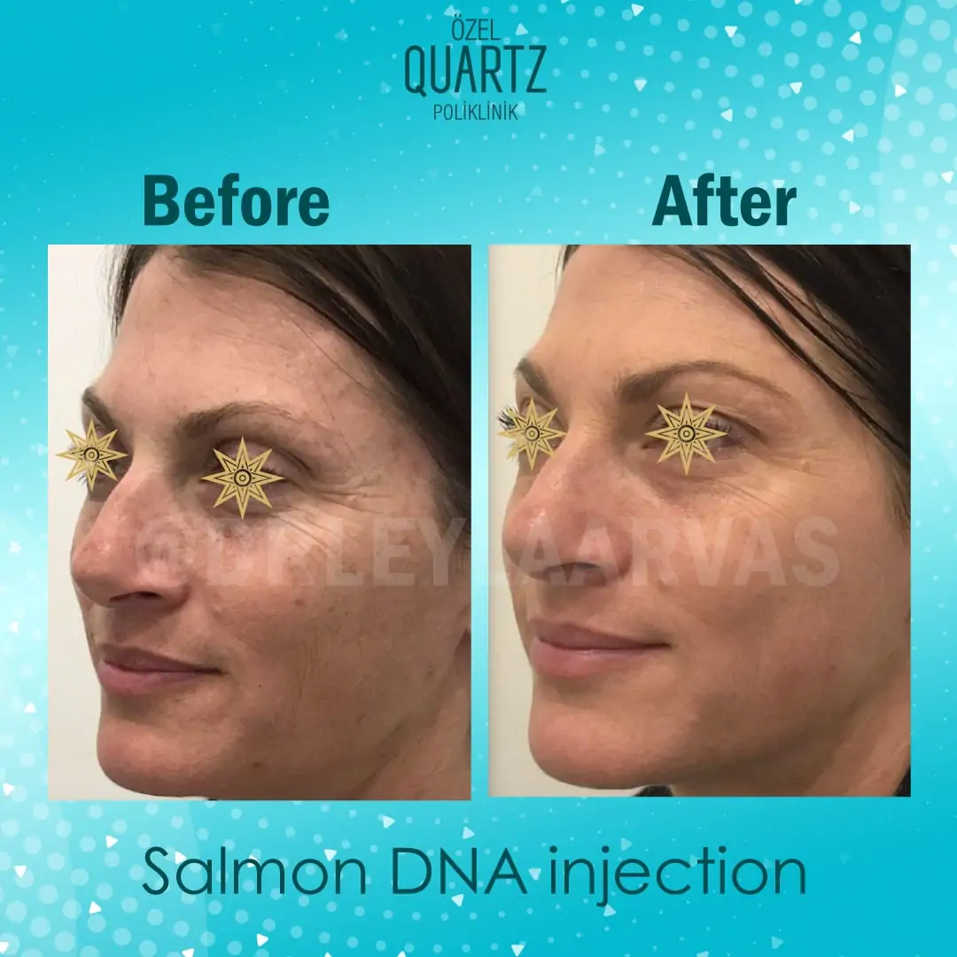Salmon DNA Vaccine Salmon DNA Vaccine