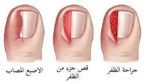 الظفر الغارز 1