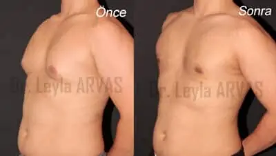 Gynécomastie