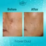 Fraxel Dual