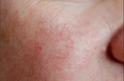 Capillary Reduction