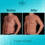 Abdominal Etching