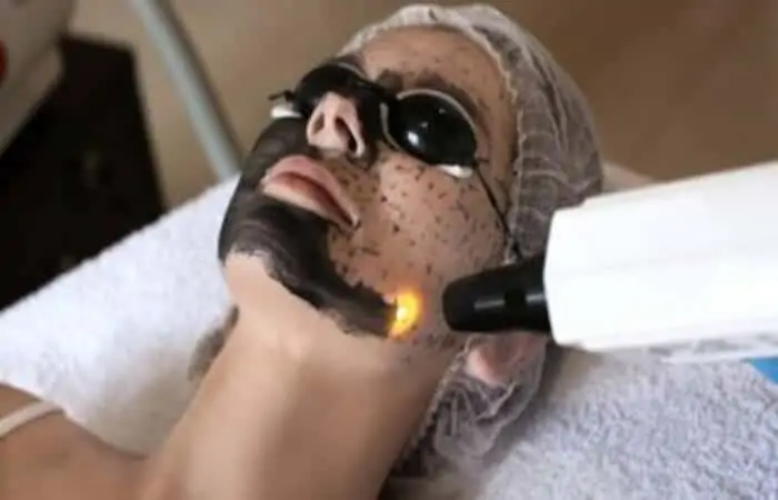 الليزر الكربوني للوجه