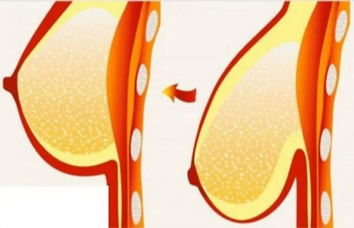 عملية تجميل الصدر